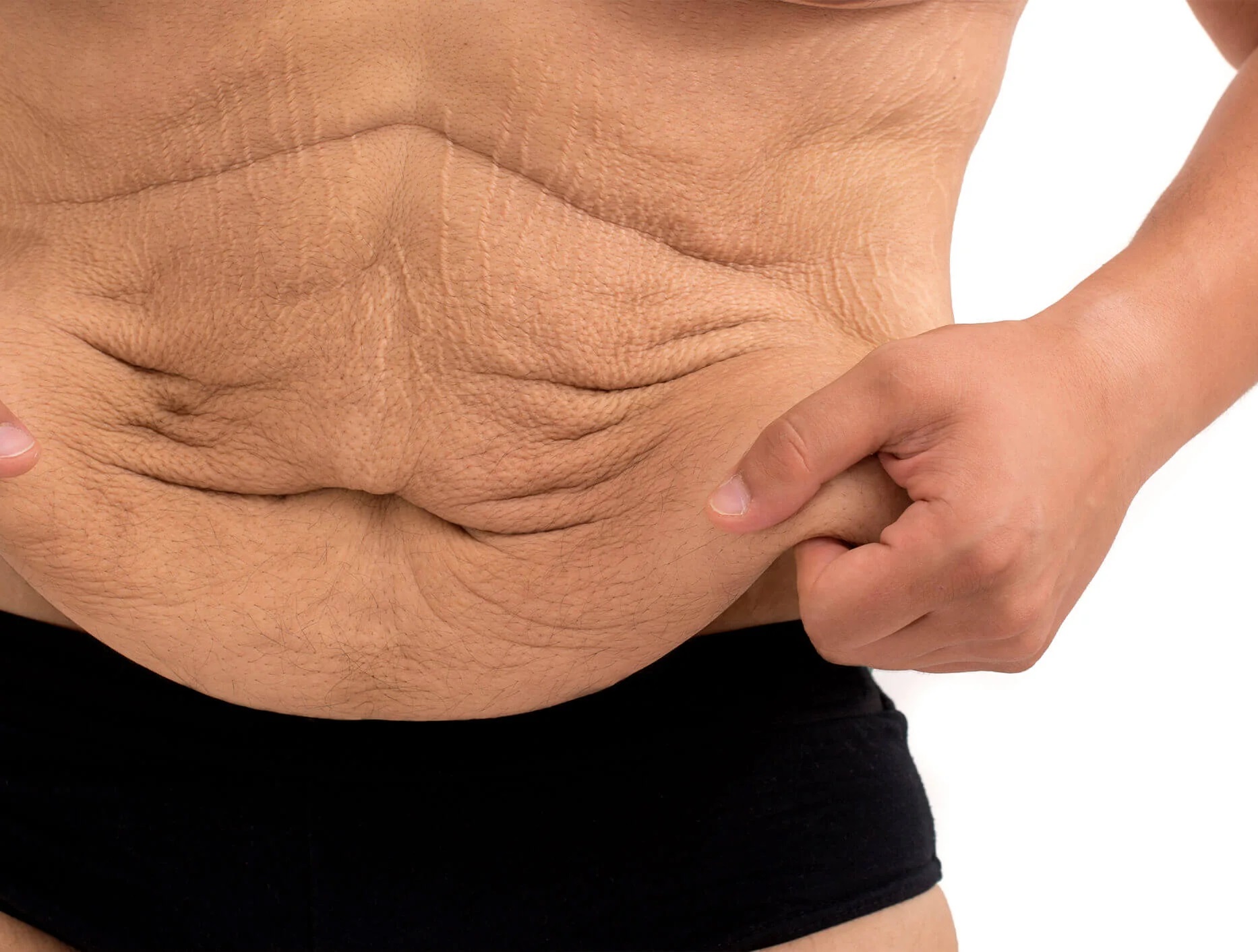 چگونه از شل شدن پوست پس از کاهش وزن جلوگیری کنیم؟